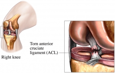 How Exercise Helps ACL Tears